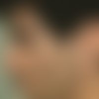 hypertrichosis, acquired circumscript. hypertrichosis on both cheeks increasing since 2 years, in...