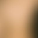 Hypertrichosis lanuginosa acquisita. Lokalisierte Hypertrichose am Rücken mit dichtstehenden, bis...