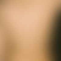 Hypertrichosis lanuginosa acquisita. localized hypertrichosis on the back with dense, up to 1.5 c...