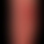 Dermatoliposclerosis in a known chronic venous insufficiency with superimposed erysipelas, which ...