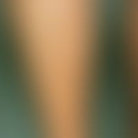 Hypomelanosis guttata idiopathica. Disseminierte, kleinfleckige Depigmentierungen im Bereich der ...