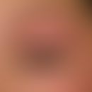 Hypothyreose. Detailvergrößerung: Linksseitiges Lidödem und Schlupflid bei einer 26-jährigen Türk...