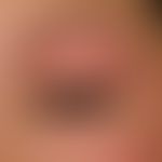 Hypothyreose. Detailvergrößerung: Linksseitiges Lidödem und Schlupflid bei einer 26-jährigen Türk...