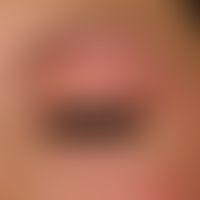 Hypothyreose. Detailvergrößerung: Linksseitiges Lidödem und Schlupflid bei einer 26-jährigen Türk...