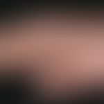 Hypothyreose. Detailausschnitt: Schwellung der rechten Hand bei einer 26-jährigen Türkin mit maxi...