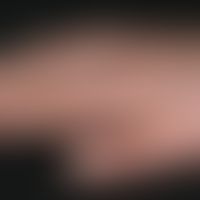 Hypothyreose. Detailausschnitt: Schwellung der rechten Hand bei einer 26-jährigen Türkin mit maxi...
