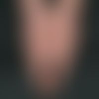 Hypothyreose. Schwellung beider Hände bei einer 26-jährigen Türkin mit maximaler Hypothyreose.