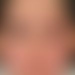 Hypothyreose. Ödem des Gesichtes mit Schwellung beider Augenlider bei einer 26-jährigen Türkin mi...