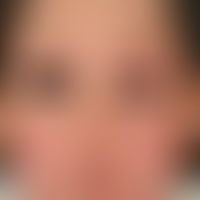 Hypothyreose. Ödem des Gesichtes mit Schwellung beider Augenlider bei einer 26-jährigen Türkin mi...
