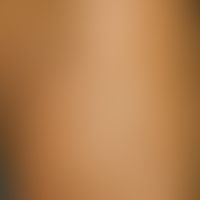 Ichthyosis congenita. Detailaufnahme des Oberschenkels: In groben Falten aufgeworfene, extrem tro...