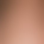 Ichthyosis follicularis. Dicht stehende, follikuläre, bräunliche Hornkegel die der Haut einen "re...