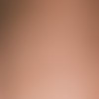 Ichthyosis follicularis. Dicht stehende, follikuläre, bräunliche Hornkegel die der Haut einen "re...