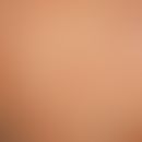 Ichthyosis linearis circumflexa. garlandlike, migrating erythema with marginal, inwardly directed...