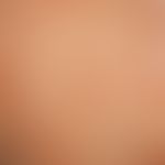 Ichthyosis linearis circumflexa. garlandlike, migrating erythema with marginal, inwardly directed...