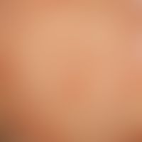Ichthyosis linearis circumflexa. garlandlike, migrating erythema with marginal, inwardly directed...