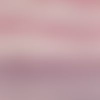 Ichthyosis vulgaris, autosomal dominant. Retention hyperkeratosis with only slightly developed or...