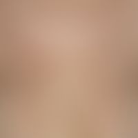 Ichthyosis vulgaris, autosomal dominant, hardening of the skin, yellowish, approximately 2 mm dia...