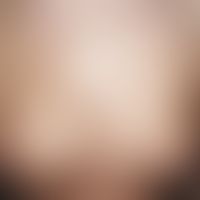 Ichthyosis vulgaris, autosomal-dominant. chronically stationary, in winter clearly deteriorated c...