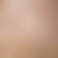 Ichthyosis vulgaris, autosomal-dominant; detail: multiple, brownish-yellowish, only slightly rais...