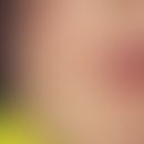 Purpura, idiopathische thrombozytopenische. Petechial-flächenhafte Blutungen in der Perioralregio...