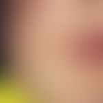 Purpura, idiopathic thrombocytopenic petechial laminar hemorrhages in the perioral region in a 2-...