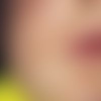 Purpura, idiopathic thrombocytopenic petechial laminar hemorrhages in the perioral region in a 2-...