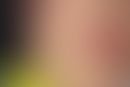 Purpura, idiopathische thrombozytopenische. Petechial-flächenhafte Blutungen in der Perioralregio...