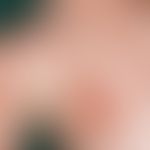 ILVEN: 5-year-old girl in whom flat and linear plaques in a characteristic arrangement along the ...