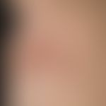 ILVEN: Clinical findings in a 17-year-old adolescent with erythematosquamous and papulokeratotic,...