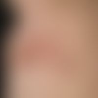 ILVEN: klinischer Befund bei einem 17-jährigen Jugendlichen. Erythematosquamöse und papulokeratot...