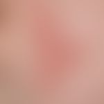 ILVEN: Since early childhood conspicuous, elongated to triangular configured papulokeratotic infl...