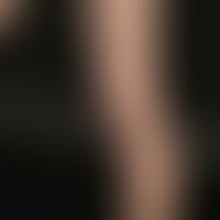 Hyperkeratotic papules in linear arrangement from the left distal lower leg to the buttocks in a ...