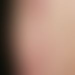 ILVEN: Chronic stationary, red, rough (hyperkeratotic), passager itchy, linearly arranged papules...