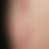 ILVEN: Chronic stationary, red, rough (hyperkeratotic), passager itchy, linearly arranged papules...