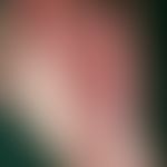 Cutaneous mosaic dermatosis: In a 7-year-old girl erythematosquamous, hyperkeratotic papules and ...