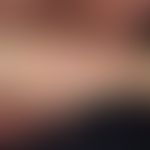 ILVEN: Acquired psoriasiform blaschko-linear inflammatory dermatosis, partly flat and partly line...