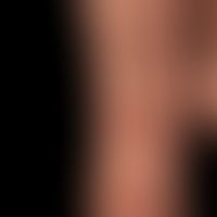 ILVEN: Linearly arranged, eczematous (histology: superficial perivascular and interstitial spongi...