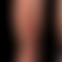 Ilven: Blaschko-lineare inflammatory "eczema-like" skin disease which developed in an otherwise c...