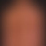 Mosaic dermatosis: Superimposed segmental manifestation as clinical manifestation of a "cutaneous...