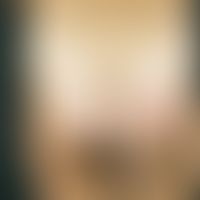 Impetigo contagiosa: Seeding of sharply defined, crusty, confluent plaques in the area of the glu...