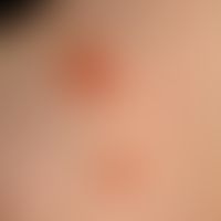Impetigo contagiosa. Akut aufgetretene, seit 5 Wochen persistierende, trotz externer Therapie zun...