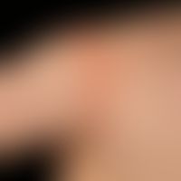Impetigo contagiosa. acutely occurring, persistent for 5 weeks, increasing despite external thera...