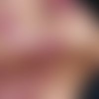 Impetigo contagiosa. multiple, chronically dynamic, persistent for 6 weeks, disseminated, homogen...