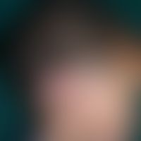 Contagious impetigo, large-bubble (bullous  impetigo)
