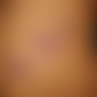 Impetigo contagiosa, large vesicles (bullous  impetigo): multiple pyoderma associated with larger...