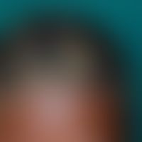 Impetigo contagiosa, kleinblasige: Ausgeprägte Impetigo bei einem 14-jähringe äthiopsichen Mädceh...