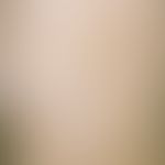 Incontinentia pigmenti achromians: multiple, permanente (angeborene), halbseitig am Rumpf lokalis...