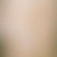 Incontinentia pigmenti achromians: multiple, permanent (congenital), half-sided on the trunk, par...