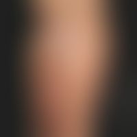 Incontinentia pigmenti achromians: Mosaic-like hypopigmentations of the left trunk and leg in a 2...
