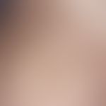Incontinentia pigmenti, Typ Bloch-Sulzberger. Girlandenförmige Pigmentierung am Oberschenkel der ...